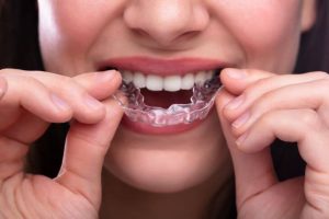 A woman wearing clear trays as a treatment for proper bite alignment.