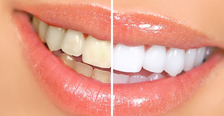 teeth before and after whitening