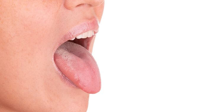 scalloped tongue