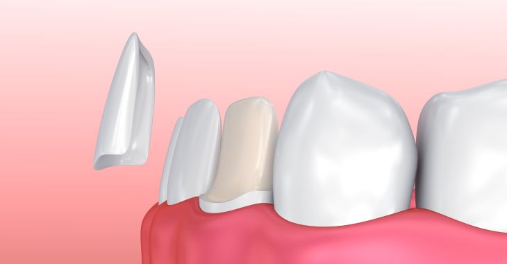 dental veneers