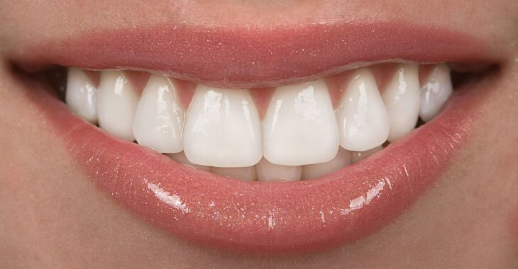 Perfect teeth after porcelain veneers application.