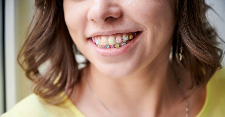 Teeth of a teenage girl wearing colored braces.