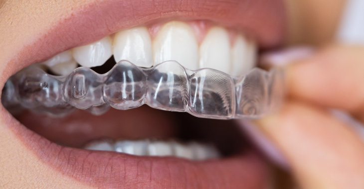 clear aligners on teeth