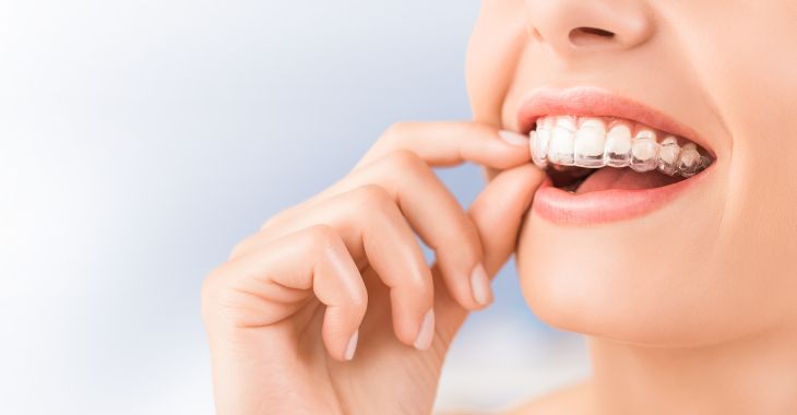 Woman wearing Invisalign orthodontic aligner.