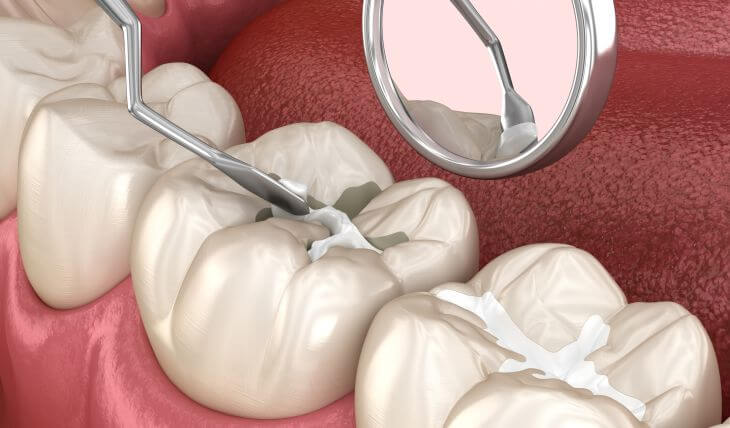 white tooth fillings