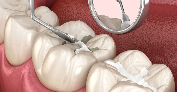 Composite dental fillings